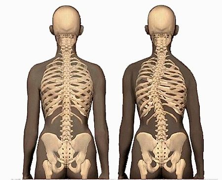 Skolyoz İçin Pilates Kursu